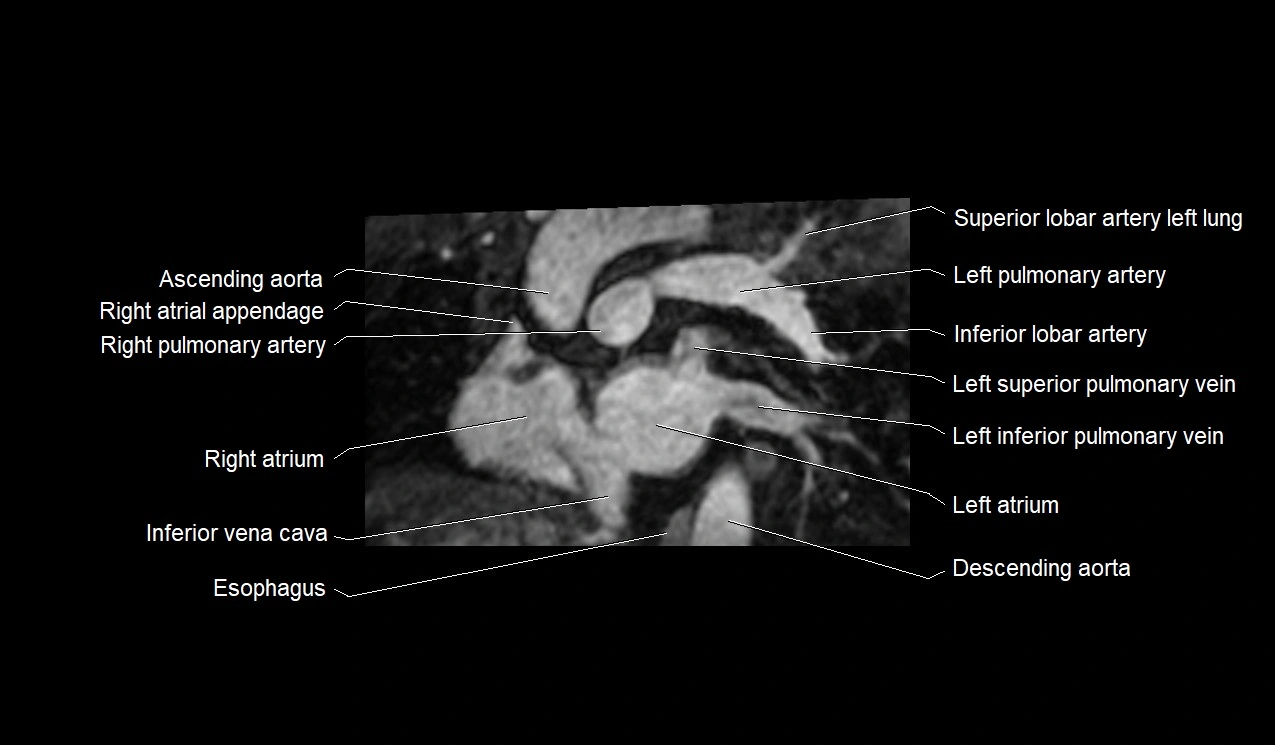 MRI heart and coronary arteries short axis anatomy image 10.webp